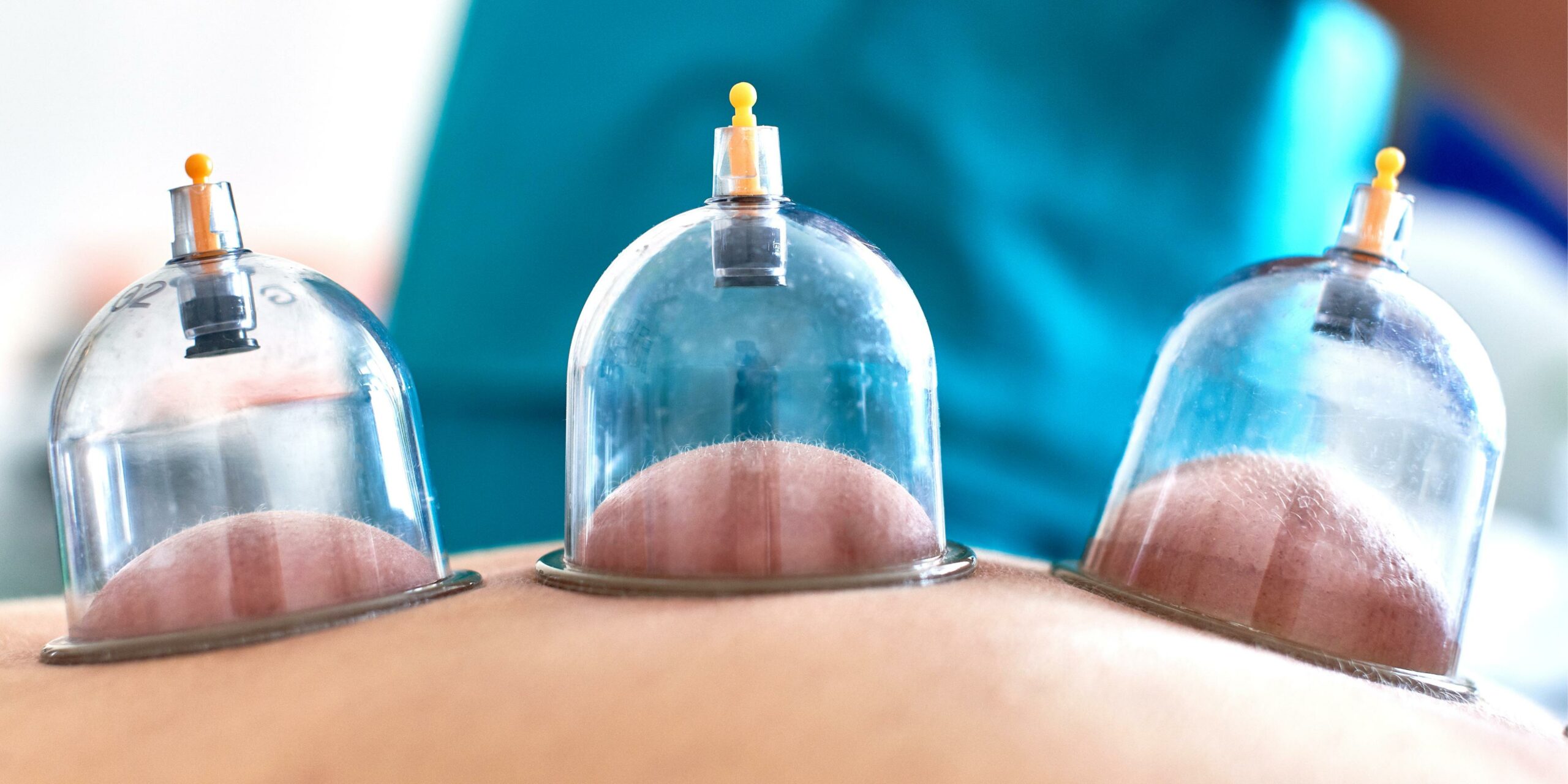 Dry Cupping
